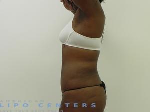 americanlipocenters_127.jpg
